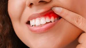 inflamed gums